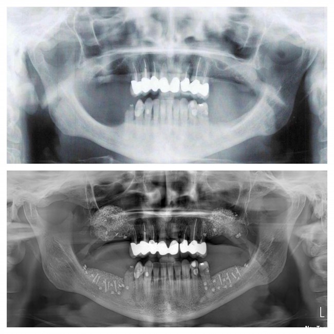 Zubní implantát nebolí a&nbsp;vrátí vám dokonalý úsměv